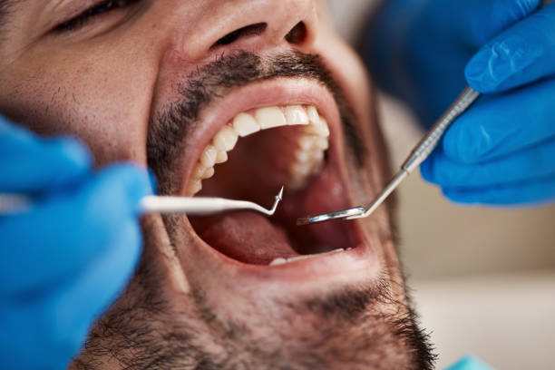 Best Emergency Treatment for Dental Infections or Abscesses in Golden Hills, CA